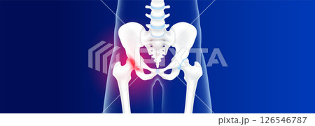 Hip bone, pelvis healthy and degenerative joint disease. Arthritis hip pain cartilage becomes worn. This results in inflammation swelling. Human skeleton with copy space for text. Realistic 3d vector. 126546787