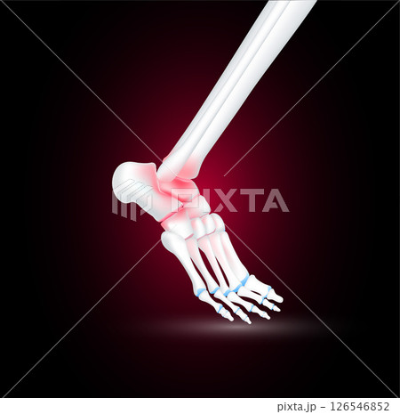 Ankle bone foot traumas and arthritis joint cartilage side on black background. Human skeleton anatomy healthy. Medical health care science concept. Realistic 3D vector. 126546852