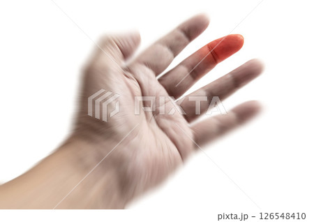 男性の手の中指に発症したヘバーデン結節 126548410