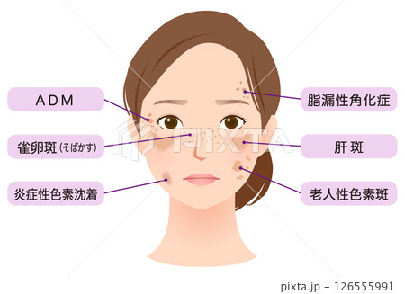 シミができた女性の顔 美容 名称 シミができた女性の顔 美容 名称 126555991