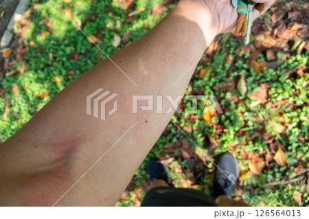 アウトドアレジャーで蕁麻疹が出る中年男性 アウトドアレジャーで蕁麻疹が出る中年男性 126564013