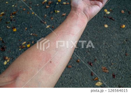 腕に蕁麻疹が出る中年男性 腕に蕁麻疹が出る中年男性 126564015