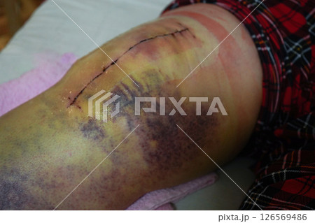Postoperative suture on woman's leg. Closeup of scar after knee fracture. Traces of interrupted sutures leg after surgery. Recovery and wound healing concept Postoperative suture on woman's leg. Closeup of scar after knee fracture. Traces of interrupted sutures leg after surgery. Recovery and wound healing concept 126569486