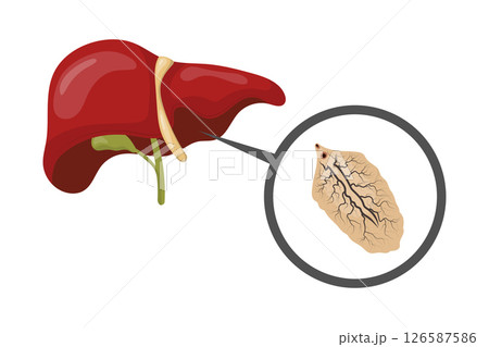 Liver fluke causing fascioliasis, infecting human liver, medical illustration 126587586