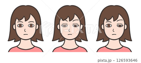 眼瞼下垂の目をした女性の顔と正常な状態 眼瞼下垂の目をした女性の顔と正常な状態 126593646
