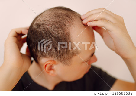 Baldness on the head of a middle-aged man. Hair loss. Male hair loss, early baldness and alopecia. 126596538