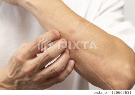 虫に刺された男性の腕 126603651