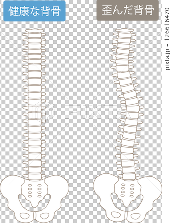 A crooked spine and a healthy spine 126616470