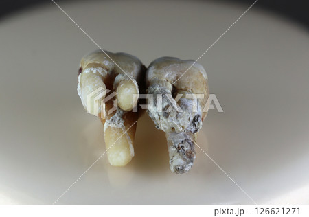 A sick, damaged human tooth. A sick, damaged human tooth. 126621271