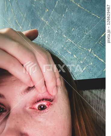 Close up of sub conjunctival heamorrhage during eye examination 126629467