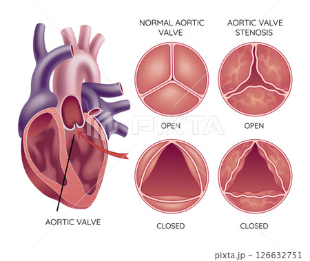 Medical illustration shows the difference between a normal aortic valve and one with stenosis, open and closed, and its location in the heart, with annotations 126632751