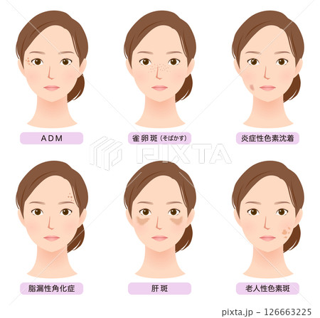 顔にできたシミの種類　美容　女性 126663225