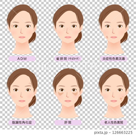 顔にできたシミの種類　美容　女性 126663225