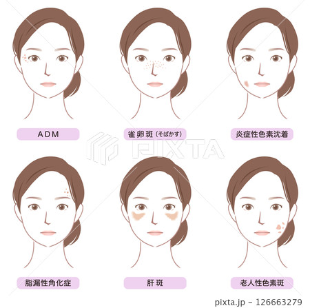 顔にできたシミの種類　美容　女性 126663279