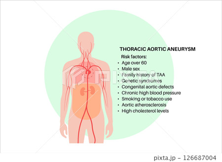 Thoracic aortic aneurysm 126687004