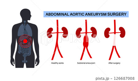 Abdominal Aortic Aneurysm 126687008