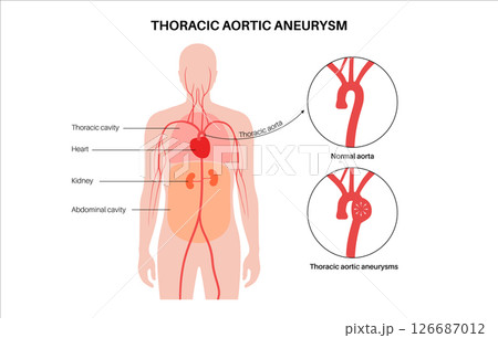 Thoracic aortic aneurysm 126687012