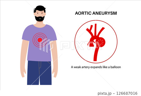 Thoracic aortic aneurysm Thoracic aortic aneurysm 126687016