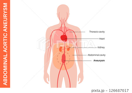 Abdominal Aortic Aneurysm Abdominal Aortic Aneurysm 126687017
