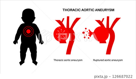 Ruptured thoracic aortic aneurysm Ruptured thoracic aortic aneurysm 126687022