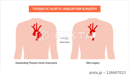Thoracic aortic aneurysm open surgery Thoracic aortic aneurysm open surgery 126687023