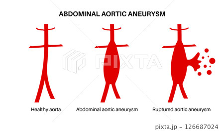 Abdominal Aortic Aneurysm 126687024