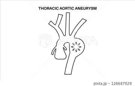 Thoracic aortic aneurysm Thoracic aortic aneurysm 126687029