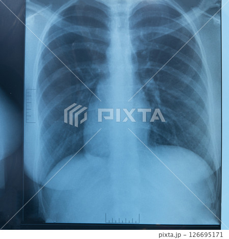 Human lung x-ray analysis, doctor examines lung disease. Pneumonia. Lung x-ray isolated on white background. Human lung x-ray analysis, doctor examines lung disease. Pneumonia. Lung x-ray isolated on white background. 126695171