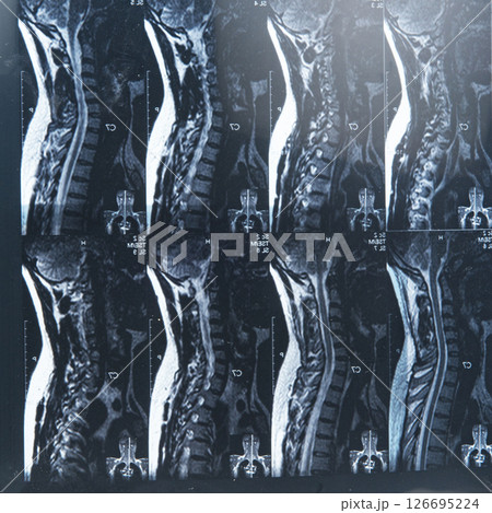 MRI xray film scan of sacro-lumbar spines of a patient with chronic back pain MRI xray film scan of sacro-lumbar spines of a patient with chronic back pain 126695224