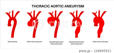 Thoracic aortic aneurysm Thoracic aortic aneurysm 126695911