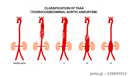 Thoracoabdominal aortic aneurysm 126695912
