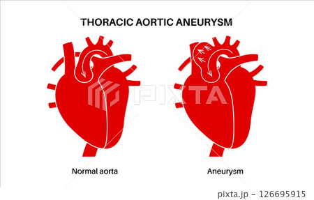 Thoracic aortic aneurysm 126695915