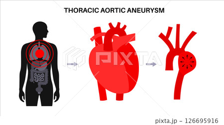 Thoracic aortic aneurysm 126695916