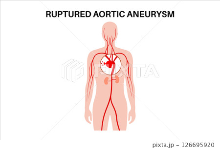 Ruptured thoracic aortic aneurysm 126695920