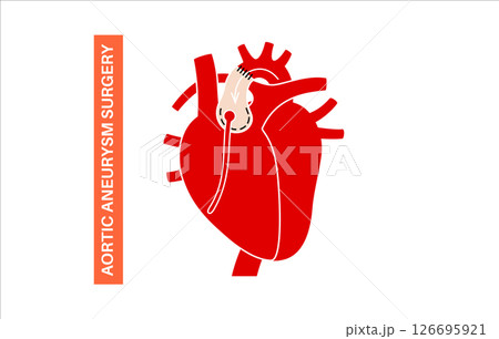 Thoracic aortic aneurysm open surgery Thoracic aortic aneurysm open surgery 126695921