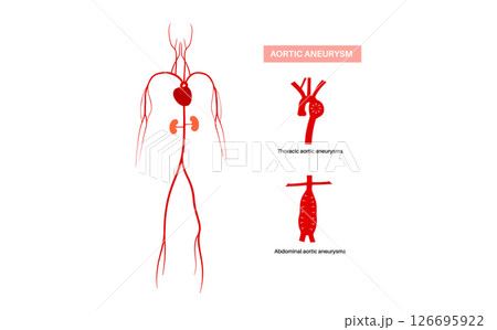 Abdominal Aortic Aneurysm 126695922