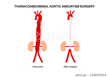 Thoracoabdominal aortic aneurysm surgery 126695924