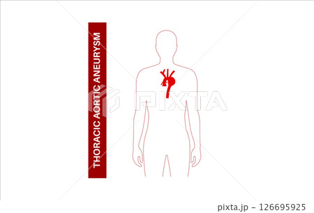 Thoracic aortic aneurysm Thoracic aortic aneurysm 126695925