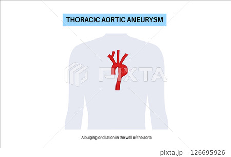 Thoracic aortic aneurysm 126695926