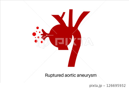 Ruptured thoracic aortic aneurysm 126695932