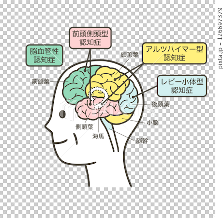 Illustration of the parts of the brain that are damaged by dementia in the elderly and their names Illustration of the parts of the brain that are damaged by dementia in the elderly and their names 126697379