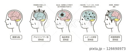 高齢者が認知症によって損傷を受ける脳の部分とその名称のイラストのセット 高齢者が認知症によって損傷を受ける脳の部分とその名称のイラストのセット 126698973