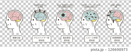 高齢者が認知症によって損傷を受ける脳の部分とその名称のイラストのセット 高齢者が認知症によって損傷を受ける脳の部分とその名称のイラストのセット 126698973