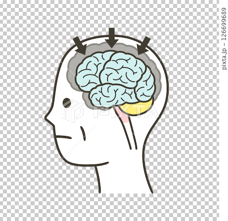 一組因阿茲海默症而受損的大腦部分的插圖 126699689