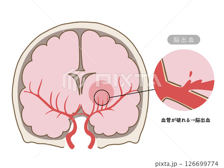 脳卒中の主な症状と脳血管の状態がわかる解剖イラスト 脳卒中の主な症状と脳血管の状態がわかる解剖イラスト 126699774