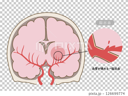 脳卒中の主な症状と脳血管の状態がわかる解剖イラスト 脳卒中の主な症状と脳血管の状態がわかる解剖イラスト 126699774