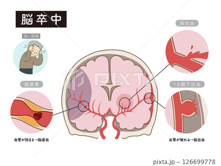 脳卒中の主な症状と脳血管の状態がわかる解剖イラスト 126699778