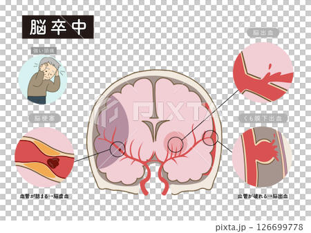 脳卒中の主な症状と脳血管の状態がわかる解剖イラスト 126699778