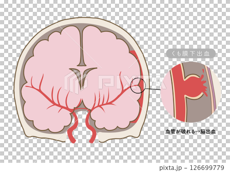 展示中風主要症狀和腦血管狀態的解剖圖 126699779