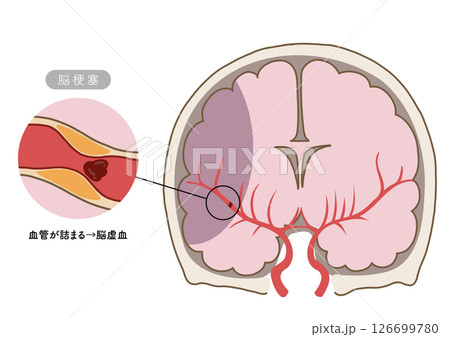 脳卒中の主な症状と脳血管の状態がわかる解剖イラスト 126699780